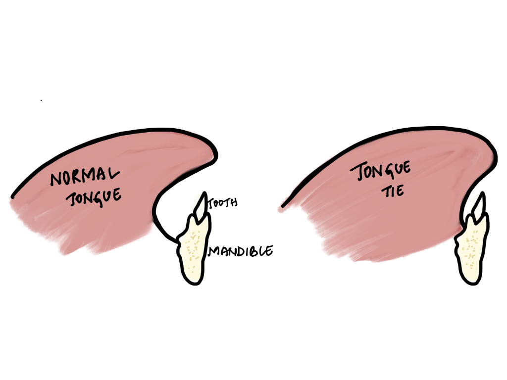 Ankyloglossia Tongue Ties