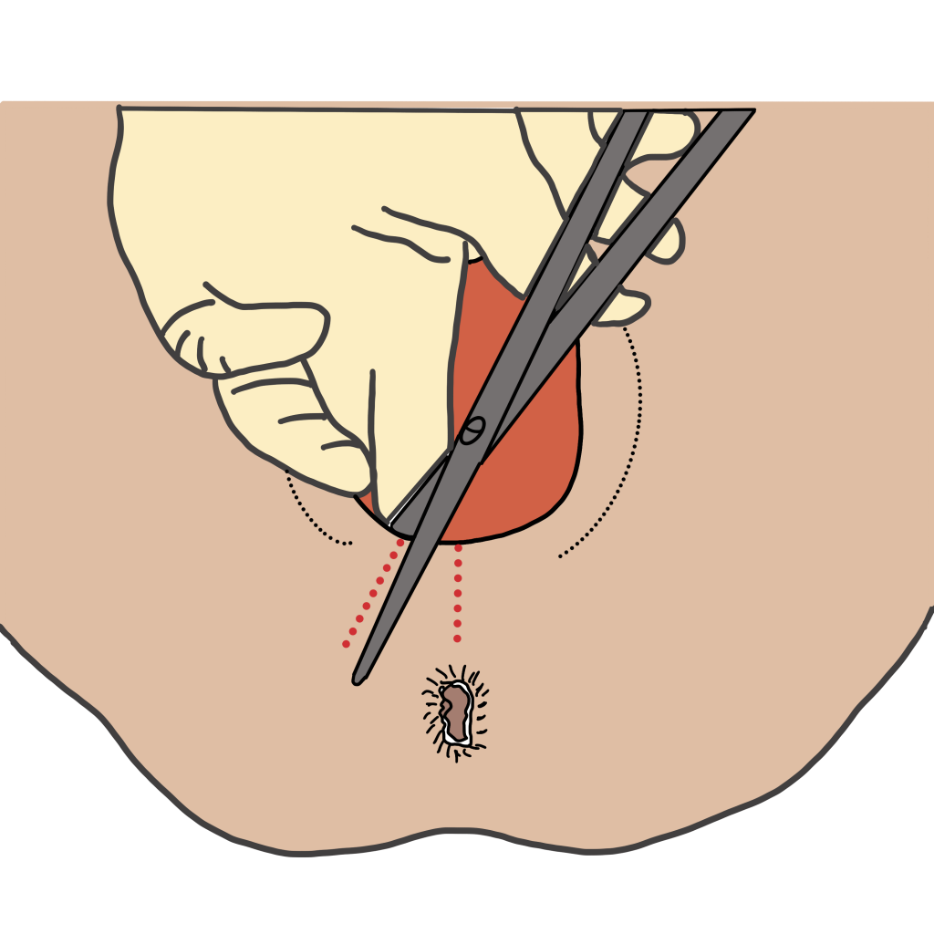 Episiotomy